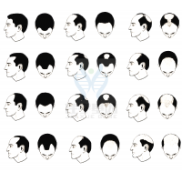 【巅峰国际基因检测】过早<font color='red'>脱发</font>、掉发太多怎么办？你的方法可能是错的！